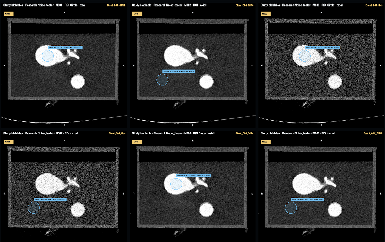 HAGRad CCTA IQ example showing six coronary CTA reconstructions with circular ROI measurements for objective image-quality comparison.