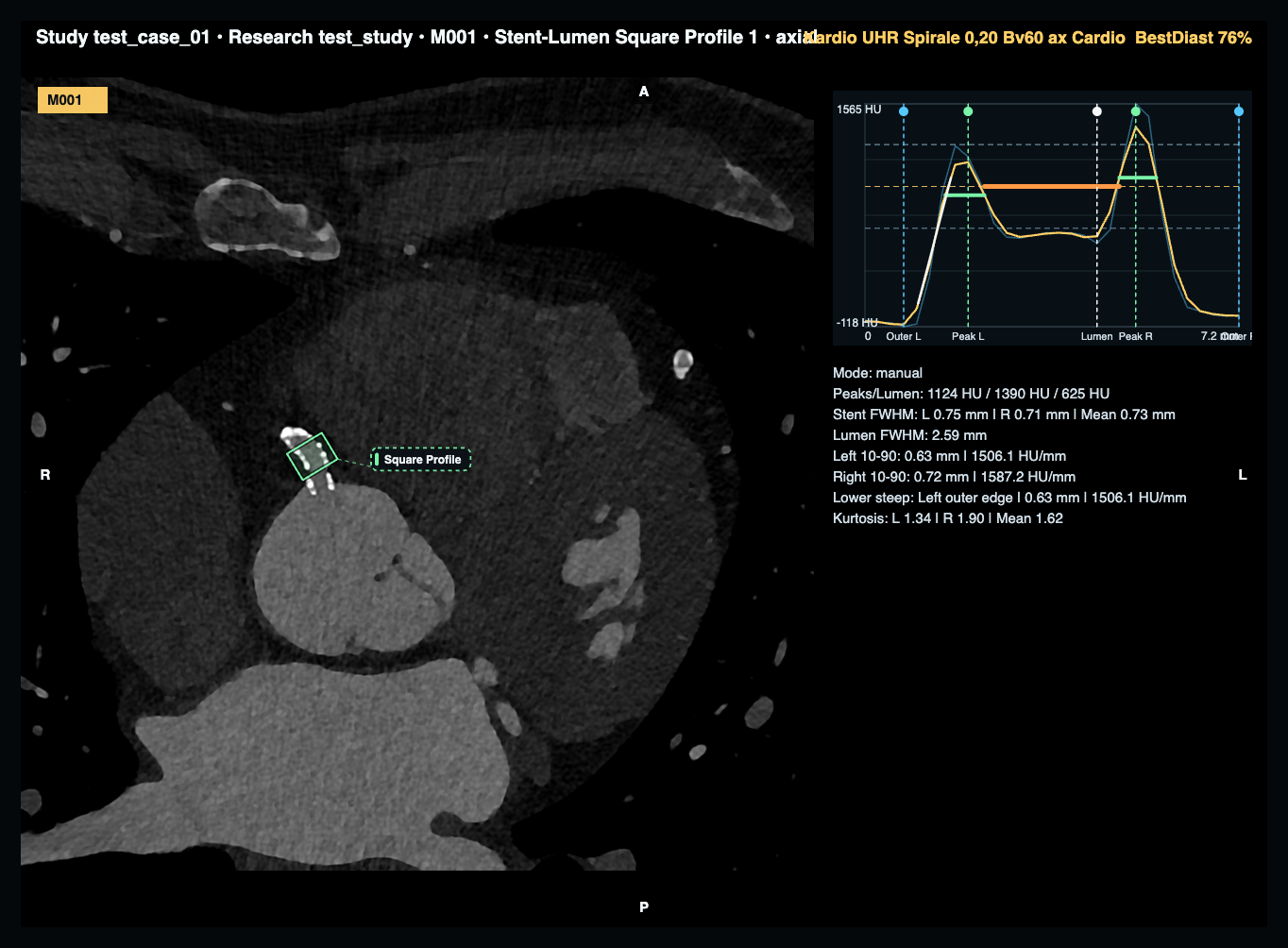 HAGRad core viewer showing axial cardiac CT, a stent-lumen square profile measurement, and the corresponding profile-analysis graph and metrics.