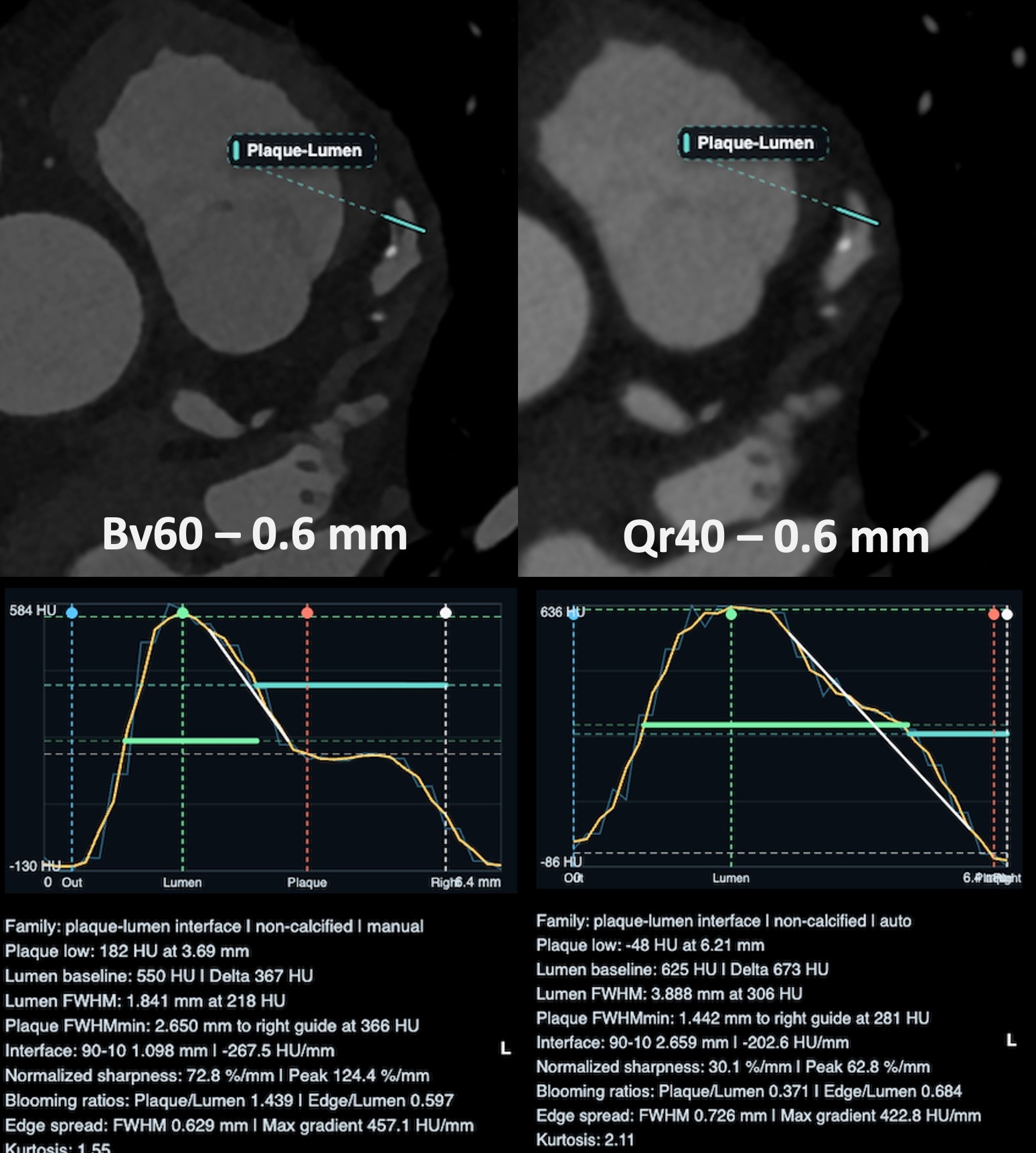 Viewer comparison of non-calcified plaque-lumen line profile analysis across Bv60 and Qr40 reconstruction kernels.