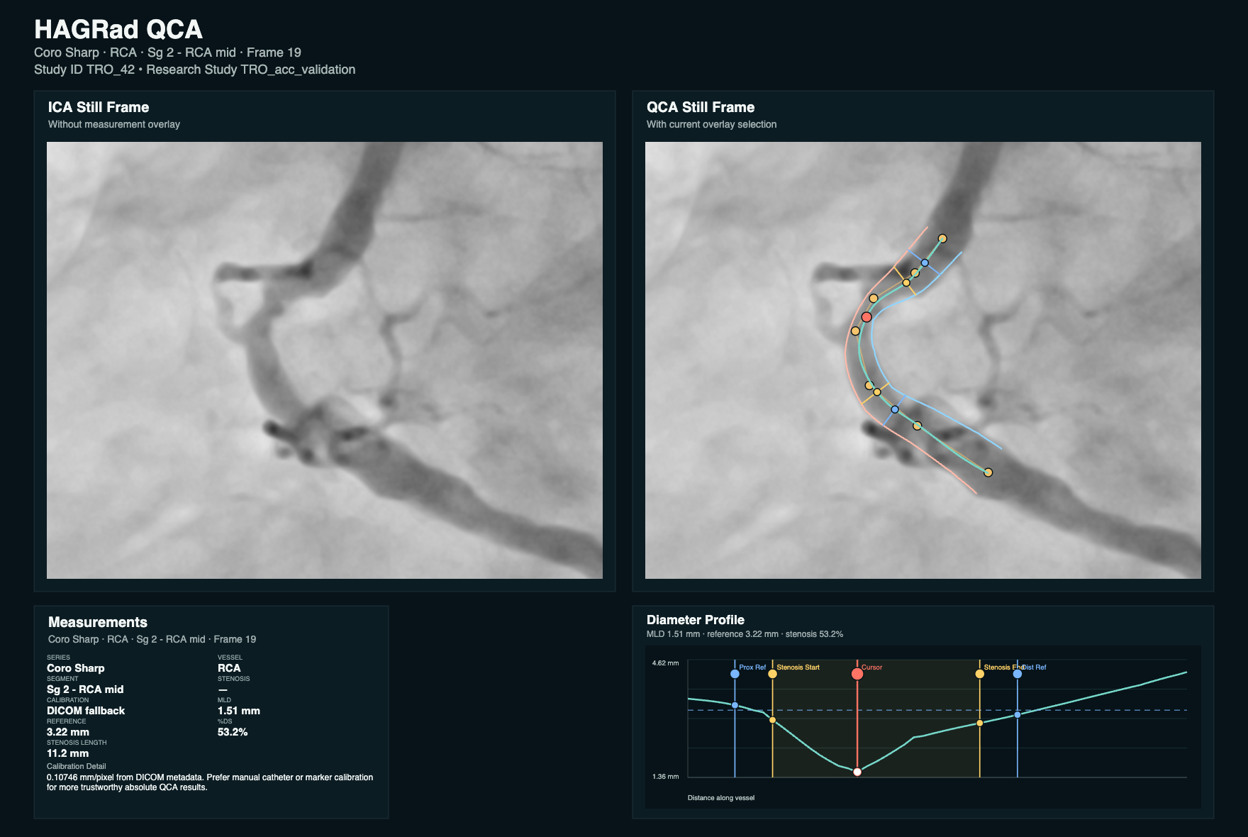 HAGRad QCA report showing an invasive coronary angiography still frame, vessel overlay, measurement table, and diameter profile for stenosis analysis.